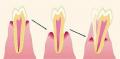 Anti-arthritics can exacerbate other inflammatory diseases like periodontitis