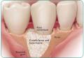 Bone loss and inflammation reversed in immune disorder by dental team