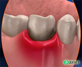 Protection from periodontitis and related chronic diseases